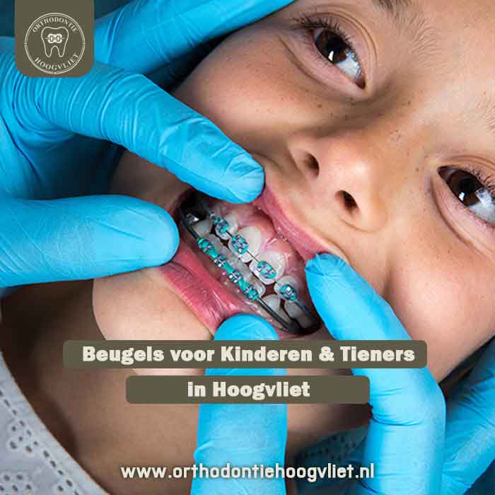 Orthodontie voor kinderen Hoogvliet - Beugel voor overbeet correctie