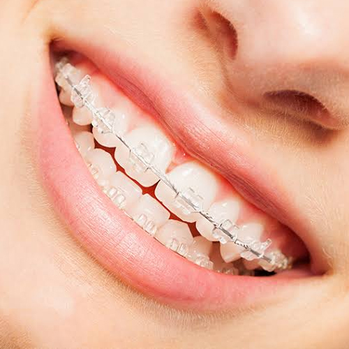 Onzichtbare en esthetische beugels - Orthodontie Hoogvliet Een close-up van een gebit met een esthetische, minder opvallende vaste beugel met doorzichtige brackets bij Orthodontie Hoogvliet.