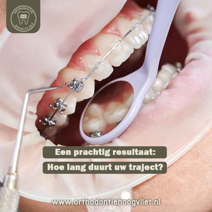 Een orthodontische controle met een mondspiegel om de duur van een beugelbehandeling in Hoogvliet te bepalen.