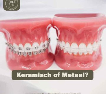 Keramische beugel Hoogvliet naast een metalen beugel - vergelijking van witte en metalen slotjesbeugel