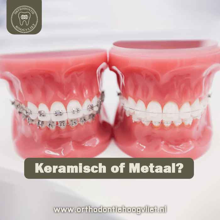 Keramische beugel Hoogvliet naast een metalen beugel - vergelijking van witte en metalen slotjesbeugel