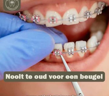 Orthodontie voor volwassenen - Nooit te oud voor een beugel