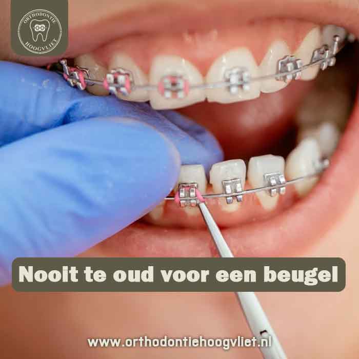 Orthodontie voor volwassenen - Nooit te oud voor een beugel